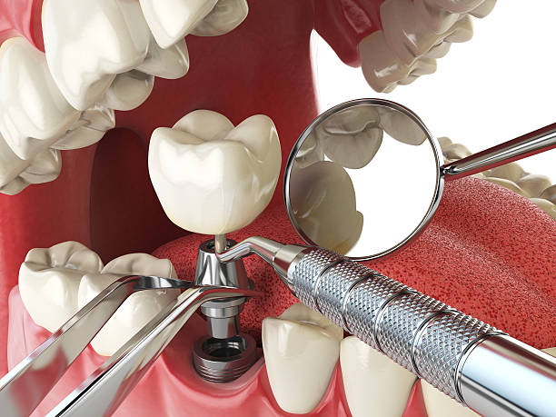 Best Emergency Tooth Extraction in Falconer, NY